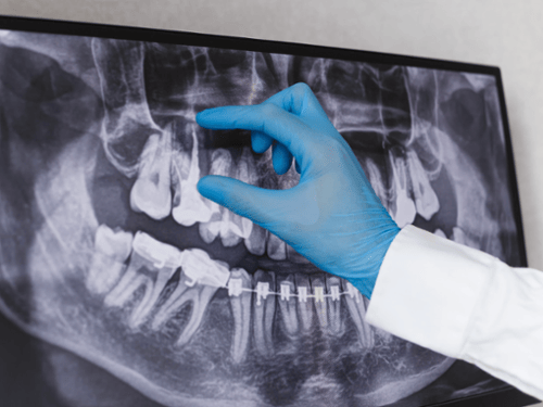 Dentist in blue glove pointing to panoramic X-ray showing full jaw and teeth structure