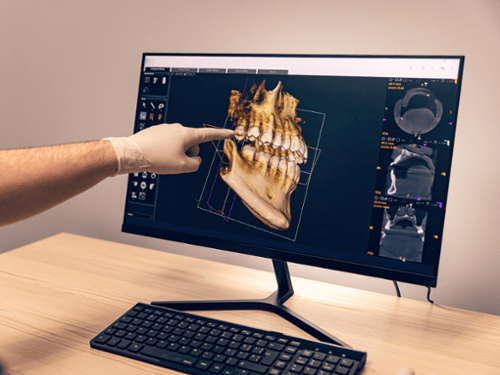 Dentist pointing at 3D CBCT cone beam scan of jaw and teeth on computer monitor
