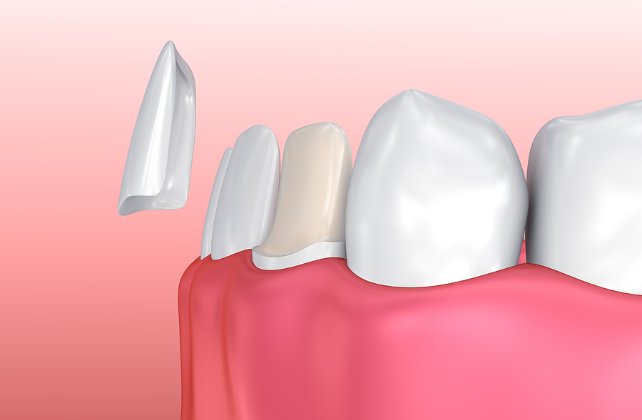 The Benefits Of CEREC Crowns