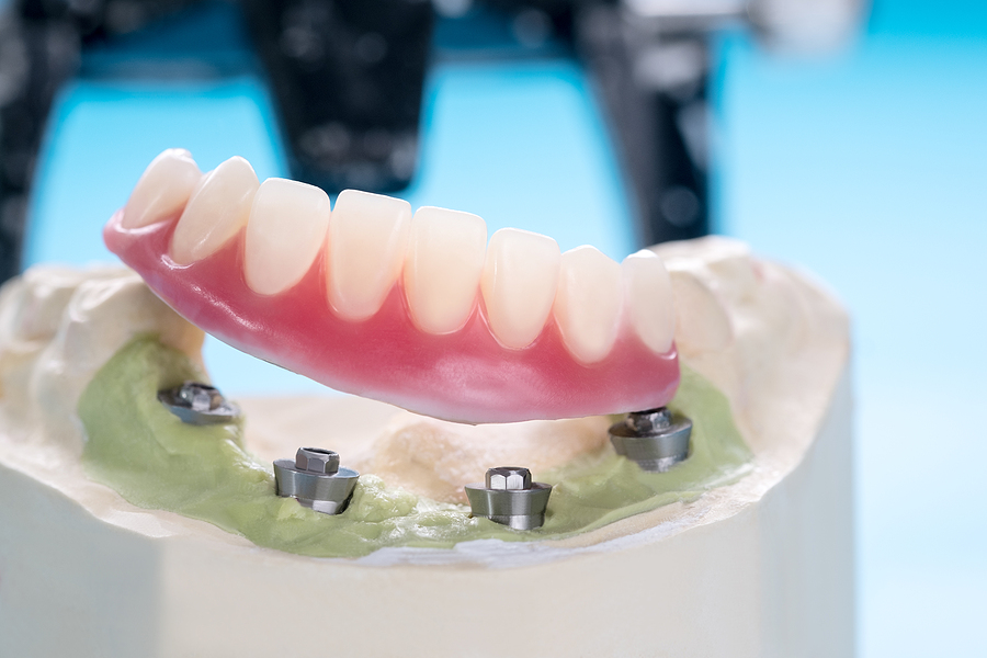 How Smoking Increases The Risk Of Implant Failure