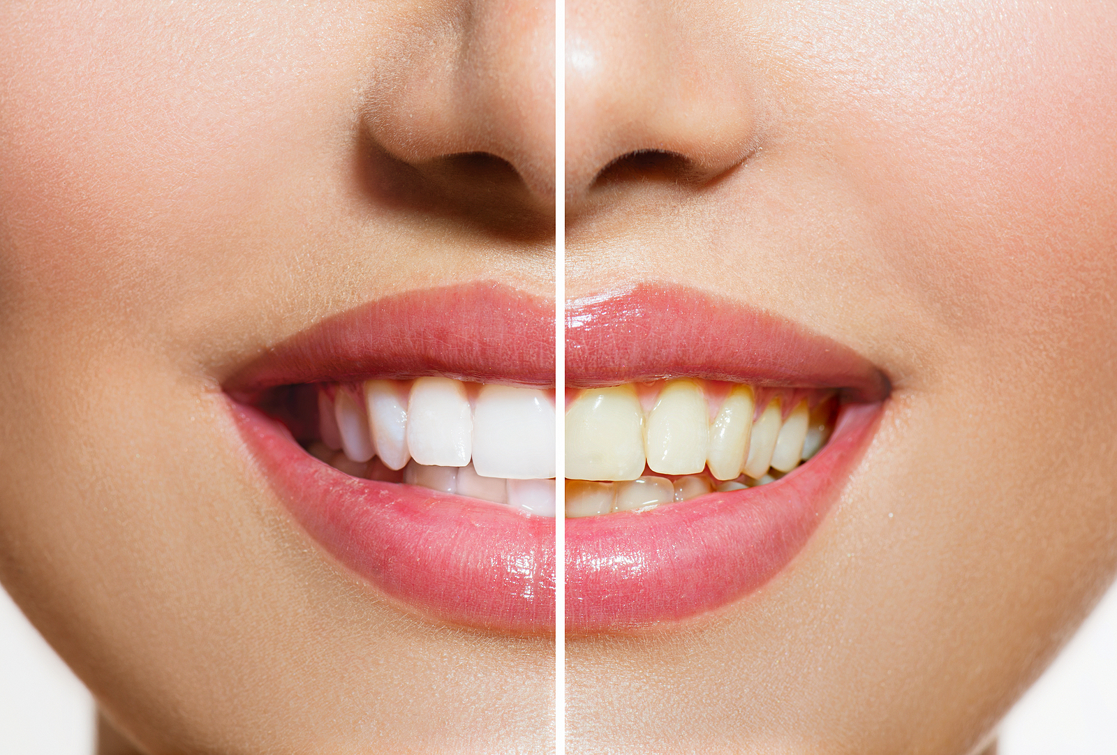 Brighten Your Smile: The Benefits of Teeth Whitening in Redmond, OR